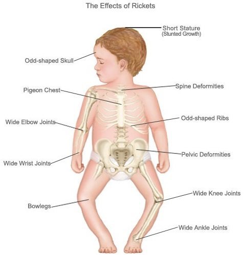 rickets.jpg